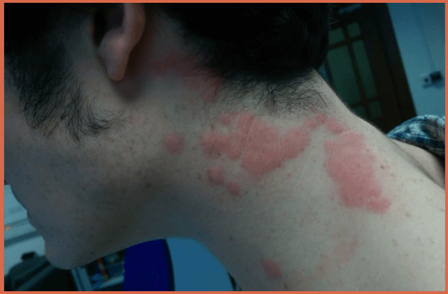 Bed Bug Allergy Picture