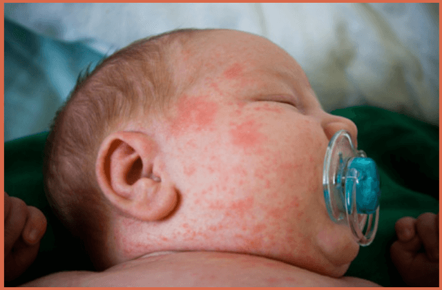 Bed Bug Rash in face of a baby