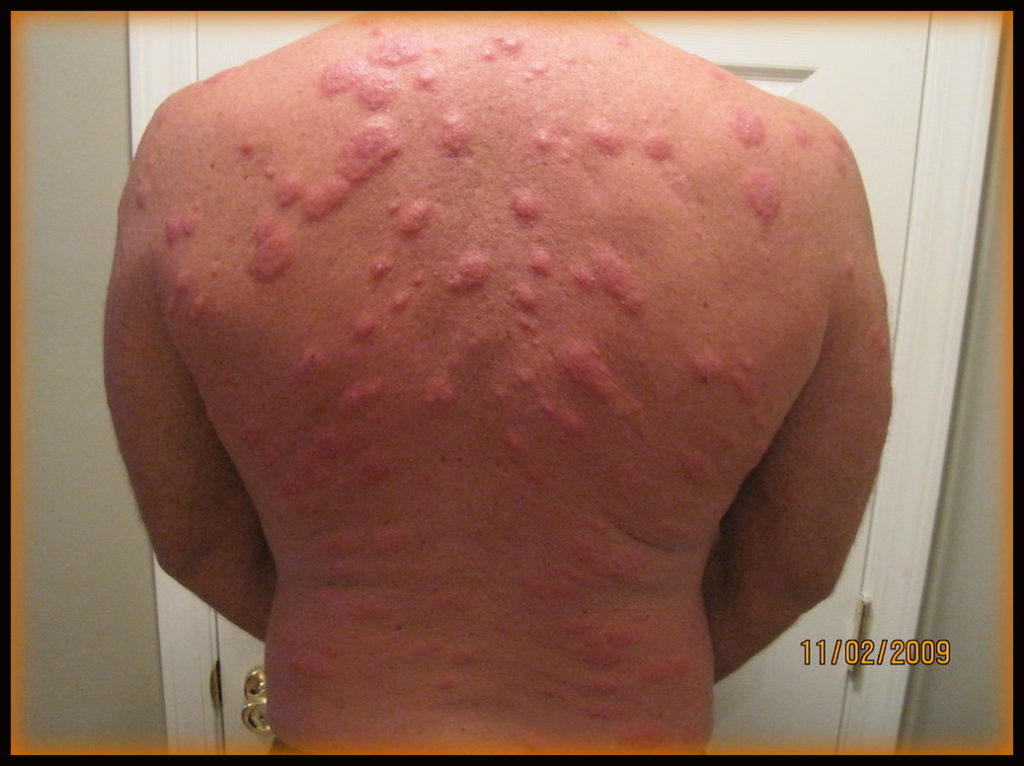 allergic reaction to bed bug bites on back
