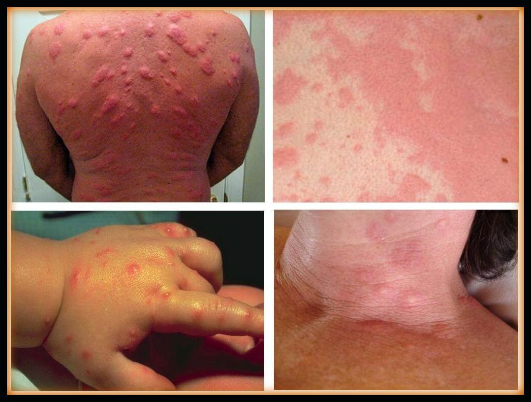 Are bed bug bites an allergic reaction