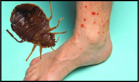 Bed Bug Bites On Feet