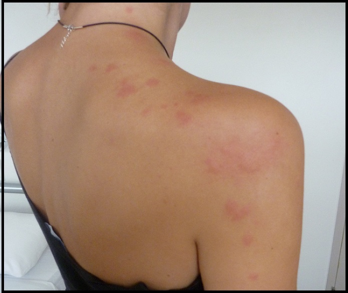 Pictures of Bed Bug Bites on Skin