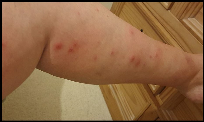 leg with bed bug bites