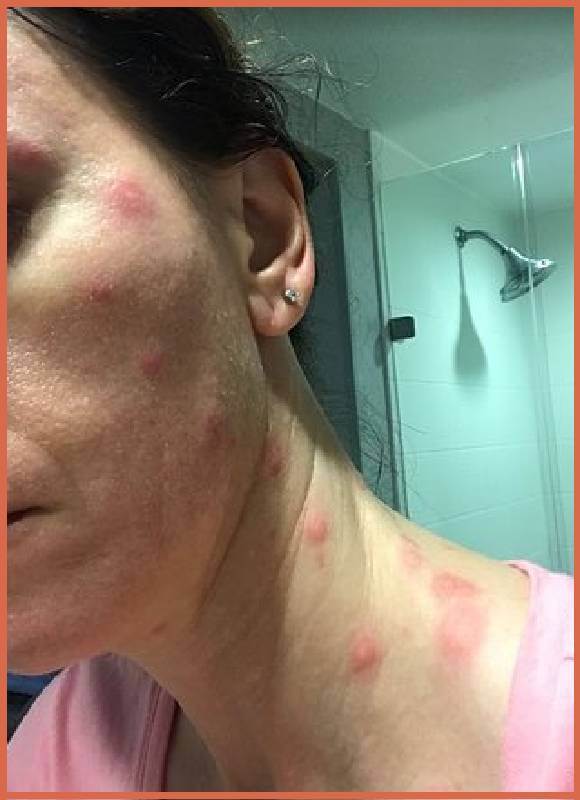 Bed-Bug-Bites-On-woman-Face