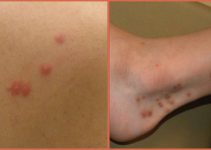 Pictures of Flea Bites and Bed Bug Bites