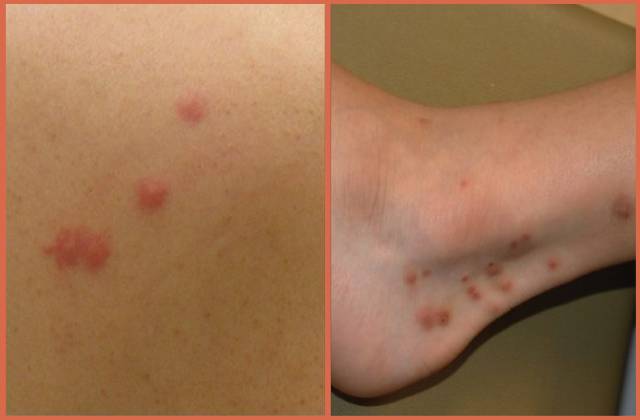 Picture-of-Flea-Bites-and-Bed-Bug-Bites