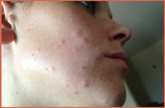 Picture-of-bed-bug-bites-on-face