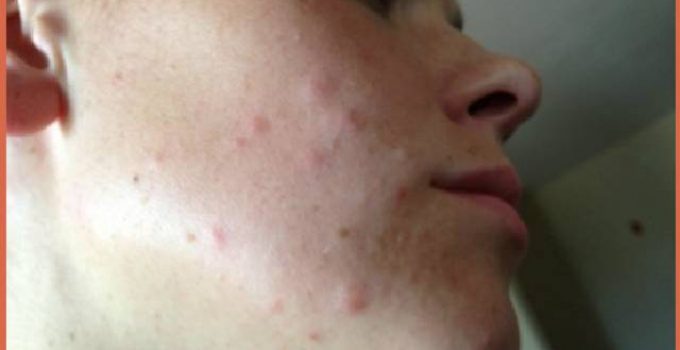 Pictures Of Bed Bug Bites On Face