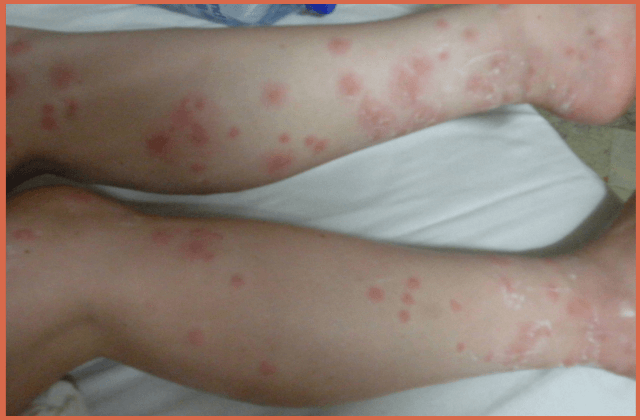 pic-of-bed-bug-bites-on-legs