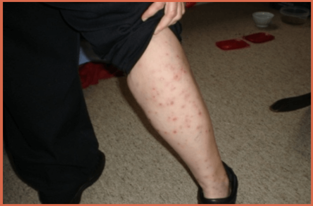 bed-bug-bites-on-right-leg-of-a-man