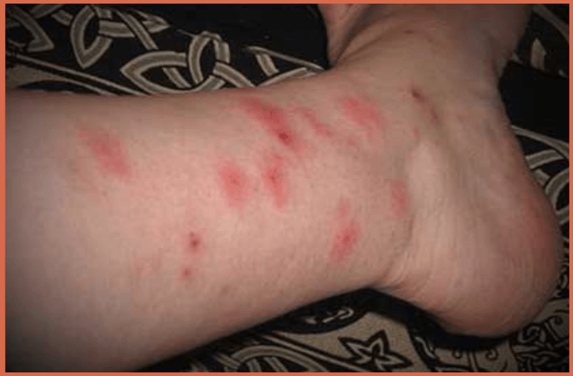 bites-on-legs-with-inflamation
