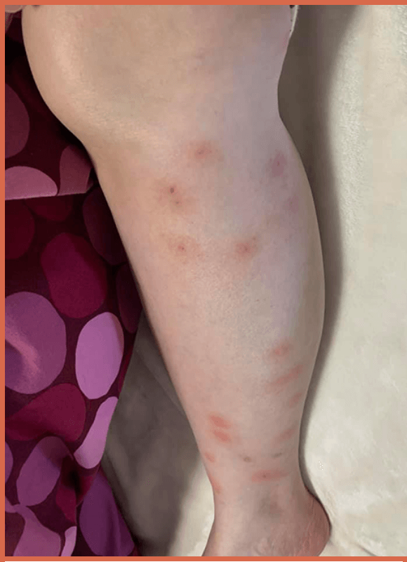 photo-of-bed-bug-bites-on-legs