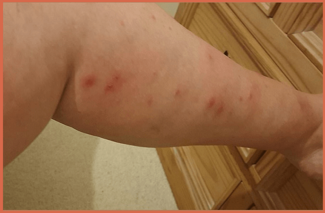 Bed-Bug-Bites-on-Legs