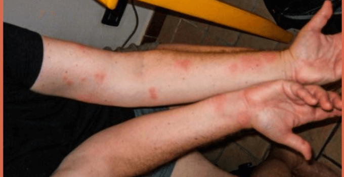 Bed Bug Bites On Arms Pictures