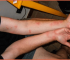 Bed Bug Bites On Arms Pictures