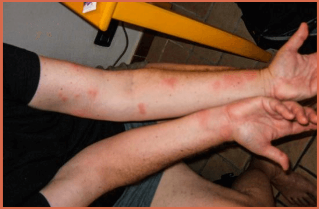 bed-bug-bites-on-arms-only
