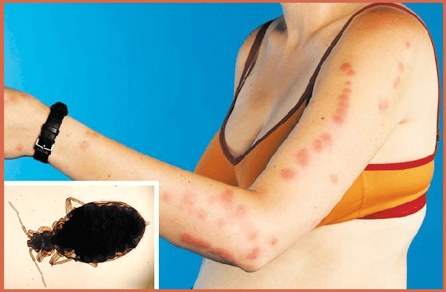 bed-bug-bites-on-arms