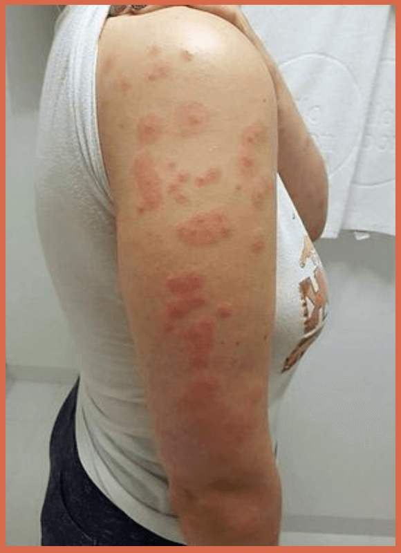 pic-of-bed-bug-bites-on-arms
