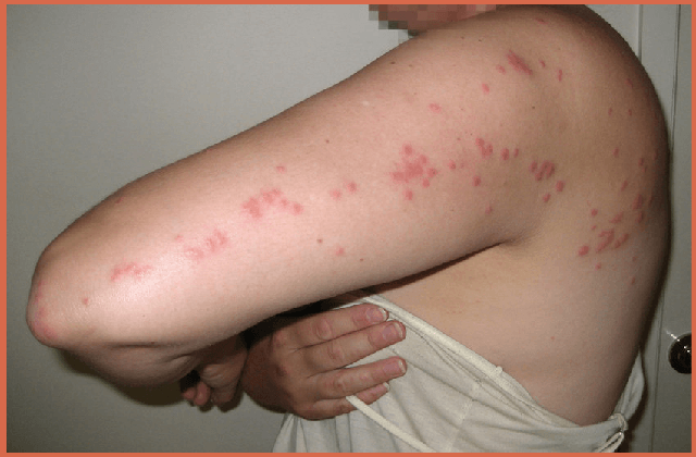 womam-with-bites-on-arm